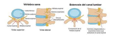 Estenosis del canal lumbar Qué es causas síntomas tratamiento y