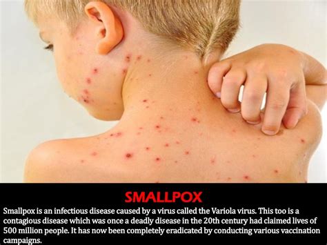 Smallpox Pictures
