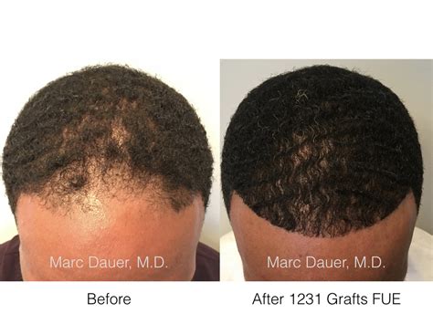 Fue Hair Transplant In African American Patient Marc Dauer Md Hair