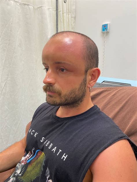 Man Develops Swollen Head After Day At The Beach Stuns Docs