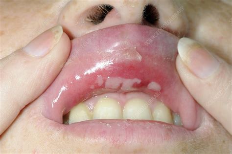 Aphthous Ulcers Inside Upper Lip Stock Image C Science Photo Library