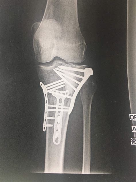 Medial Tibial Plateau Fracture