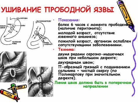 Диета операция язва желудка Прободная Язва Желудка Операция Диета — Похудение Диета Правильное Питание Прободная Язва Желудка Операция Диета — Похудение Диета Правильное Питание Диета операция язва желудка