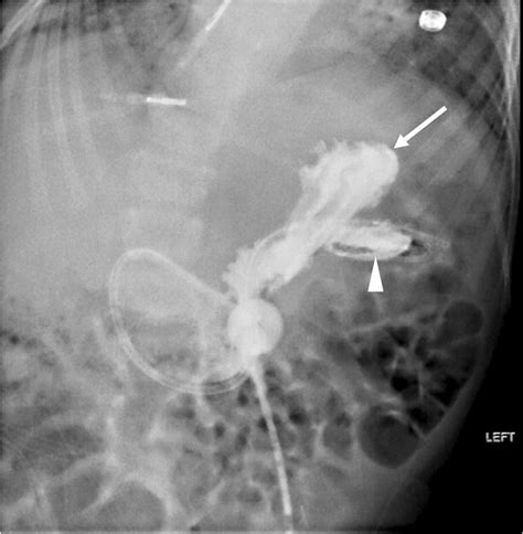 Rupture Of The Jejunal Port Of A Gastrojejunostomy Tube In The Stomach