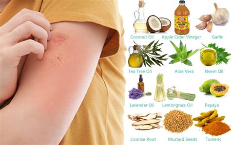 How To Get Rid Of Ringworm Overnight The Best Way Of Home Remedies