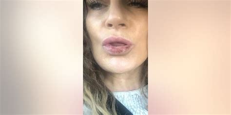 Moms Lips Left Oozing Pus After Low Cost Fillers Fox News