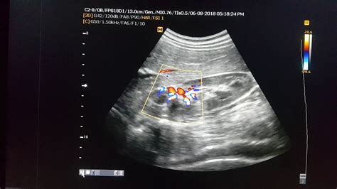 Malrotated Kidney Ultrasound Youtube