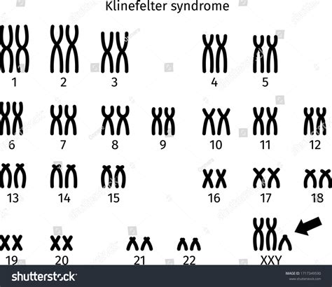 Scheme Klinefelter Syndrome Karyotype Human Somatic Stock Vector
