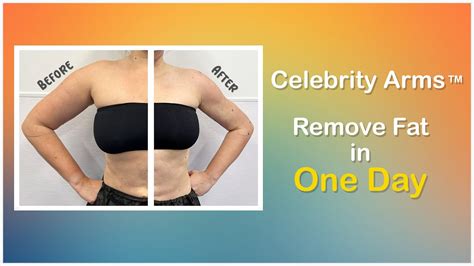 Celebrity Arms Liposuction Lipo Arms High Definition Expert