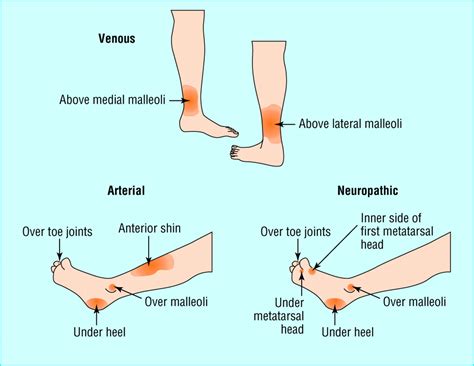 Venous and arterial ulcers are open wounds that commonly occur on your lower legs and feet. Ulcerated lower limb | The BMJ