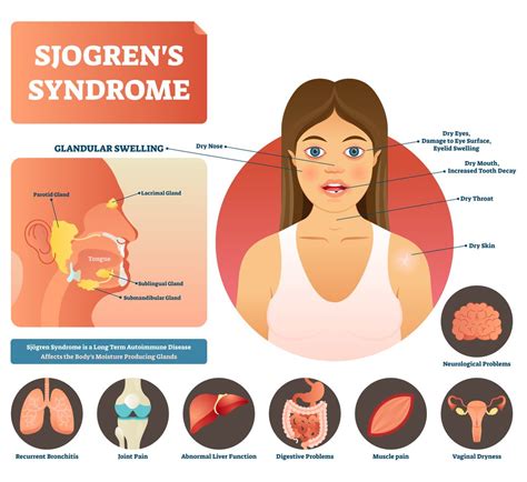 Sjogrens Syndrome Overview Causes Symptoms Treatment
