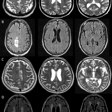 Examples Of The Brain Mri Findings Associated With Cryptococcus