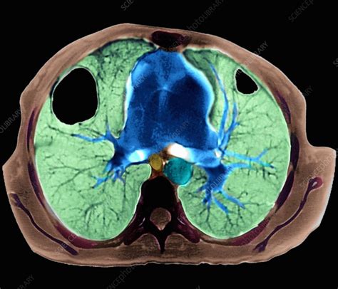 Lung Abscesses Ct Scan Stock Image M1080548 Science Photo Library