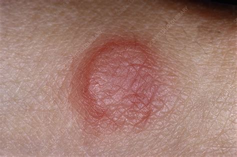 Skin Lesion Stock Image C0514697 Science Photo Library