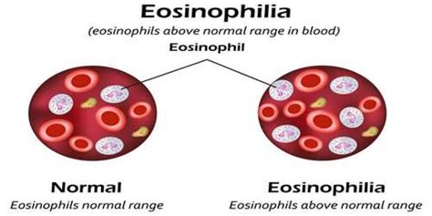Eosinophilia Assignment Point