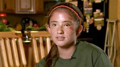 12 Year Old Girl Thought She Was A Goner In Bear Attack Bear Attack
