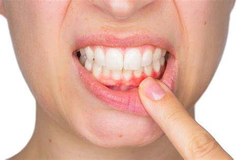 Gingivitis Vs Periodontitis The Importance Of Gum Health Beautiful Smiles Of Long Island In