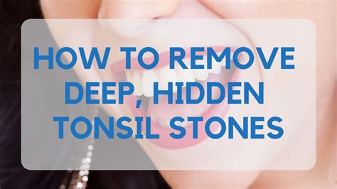 How To Remove Deep Hidden Tonsil Stones Tonsilstonecure