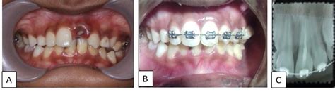 Figure 1 From Management Of Avulsed Teeth Using Fixed Orthodontics