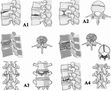 Compression Fracture Grading