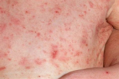 Scabies Pictures Rash Resource Scabies Rashes Scabies Vrogue Co