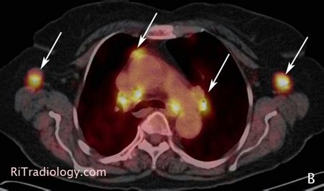 Rit Radiology Sarcoidosis On Petct