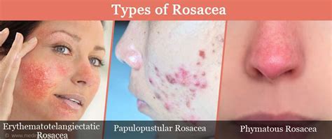 Rosacea What You Need To Know About That Redness And Flushing On Your Face
