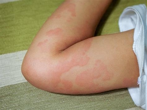 7 Reasons You Could Be Breaking Out In Hives And How To Deal With Them