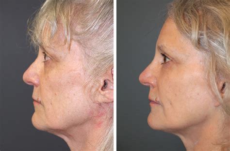 Natural Surgical Facelift Pictures Boston Ma Patient 16128