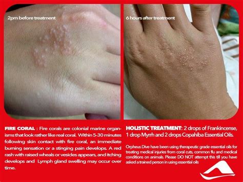 Chicken Pox Scars Holistic Treatment Eczema Psoriasis Hives