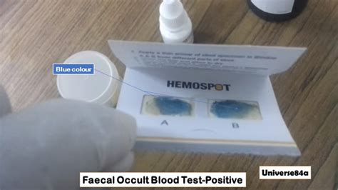 Faecal Occult Blood Test Introduction Principle Procedure Result Interp