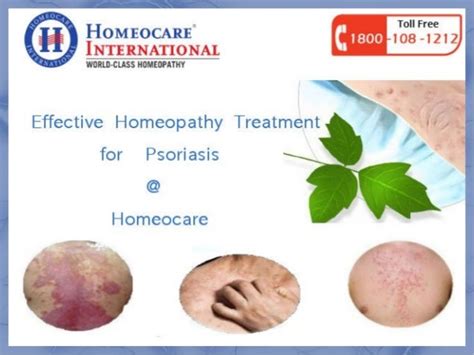 Cure Your Psoriasis Skin Diseases Through Homeopathy