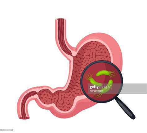Human Stomach And Helicobacter Pylori Magnifying Glass With Bacteria