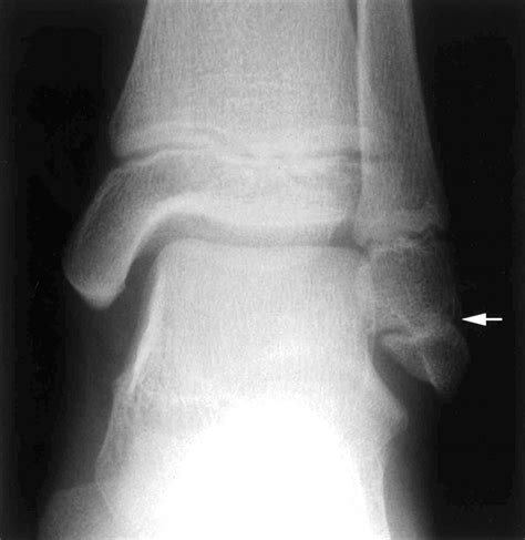 Accessory Ossicle Or Intraepiphyseal Fracture Of Lateral Malleolus Are