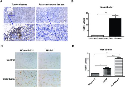 Mesothelin Expression In Carcinoma Tissues And Cell Lines Of Breast