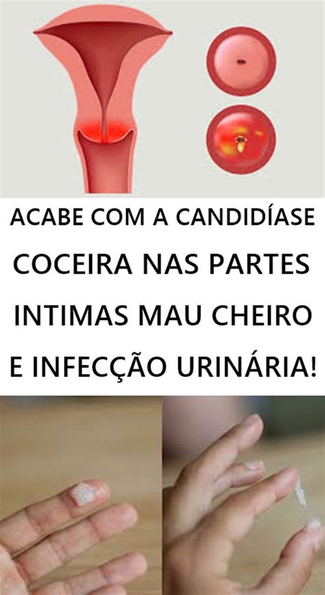 ACABE COM A CANDIDÍASE COCEIRA NAS PARTES INTIMAS MAU CHEIRO CORRIMENTO