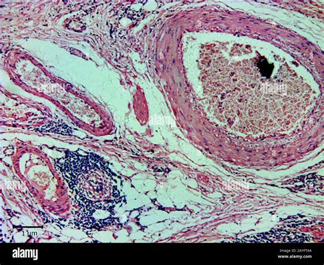Histological Cut Of Tissue Of Gastric Cancer 500 X Stock Photo Alamy