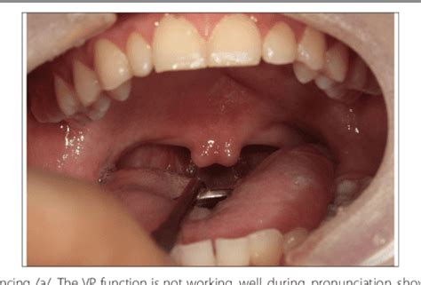 Treatment Of Velopharyngeal Insufficiency In A Patient With A Submucous