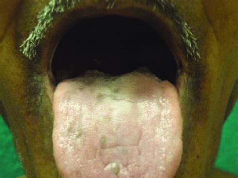 Red Spots On Tongue