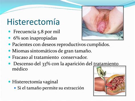 PPT Miomatosis Uterina Y Otros Tumores PowerPoint Presentation Free Download ID
