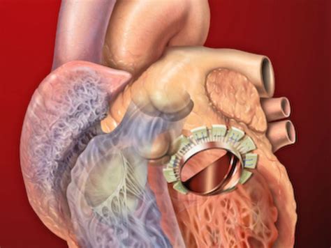 Nice Approves Heart Valve Repair Procedure For Nhs Patients
