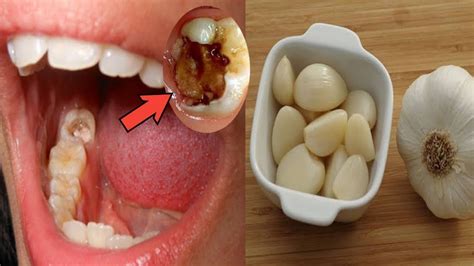 Sakit gigi sering disebabkan oleh gigi berlubang. CARA MENGOBATI SAKIT GIGI BERLUBANG, HILANG DALAM SEKEJAB ...
