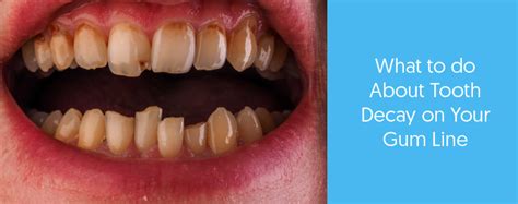 Tooth Decay At Gum Line How To Stop This Today Dental Aware Australia