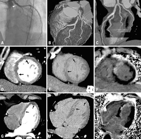Images Obtained For A 59 Year Old Man With Anteroseptal Myocardial