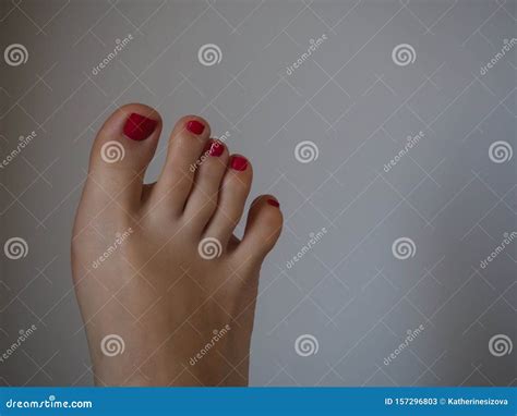 Woman`s Feet With Abnormal Twisted Shape Of Little Finger Foot