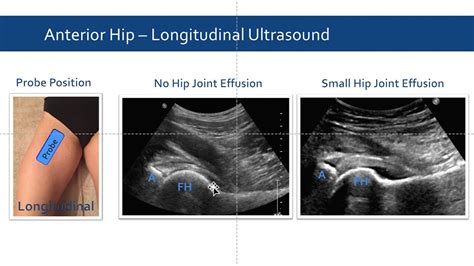 Ultrasound In Hip Pain And Arthrocentesis Youtube
