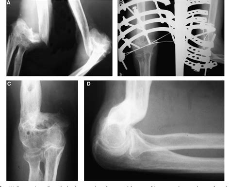 Pdf Treatment Of Post Infection Nonunion Of The Supracondylar Humerus
