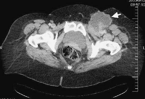 Ct Scan Showed Necrotic Enlarged Packing Of Lymph Nodes In The Left