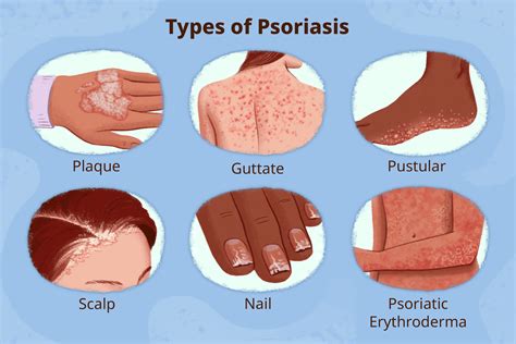 Pustular Psoriasis Face