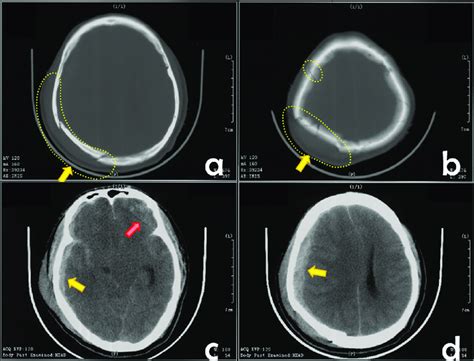 Emergency Ct Slices Of The Traumatic Head A And B Scalp Swelling And